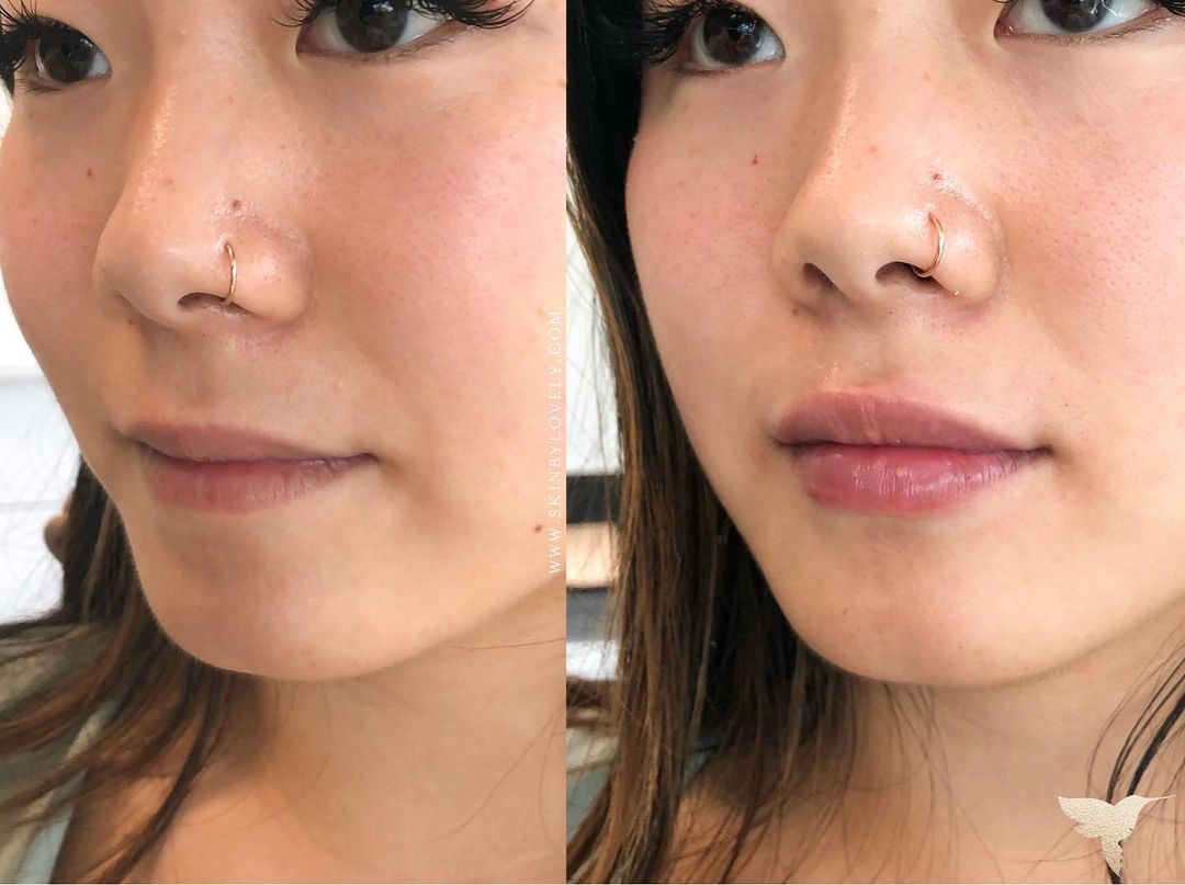 Perfekte Lippen mit restylane kyss – erhältlich bei MorySkin